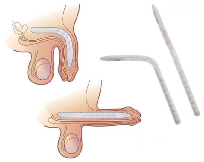 Falloplasty chun ball a mhéadú