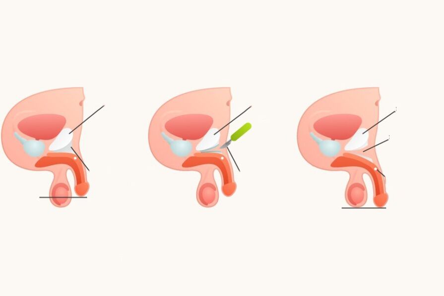 Ligamentotomy chun bod a mhéadú