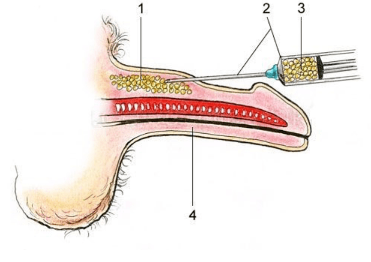 Lipofiling chun ball a mhéadú