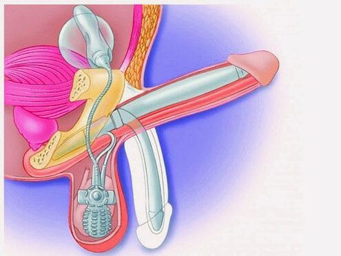 Méadú bod trí próistéise penile